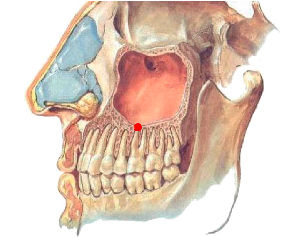 Viršutinių dantų šaknų cista gali išaugti į žandikaulio sinusą.