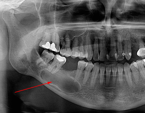 Dans certains cas, le kyste atteint une taille très impressionnante et commence à menacer la santé des dents voisines.