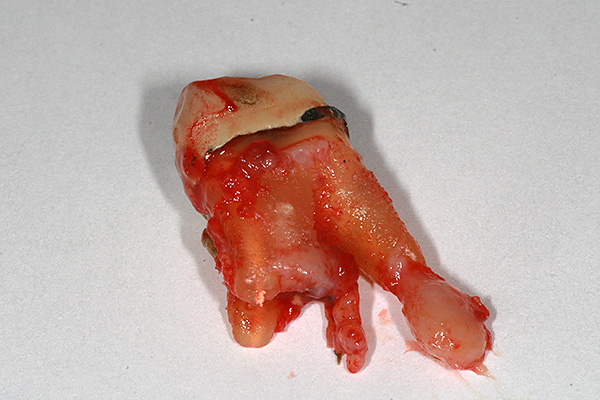 Dalam kebanyakan kes, gigi dengan sista pada akar mesti dikeluarkan, tetapi rawatan konservatif neoplasma sering mungkin.