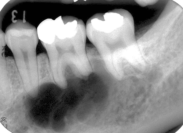 Príklad situácie, keď cysta zachytí korene dvoch zubov naraz.