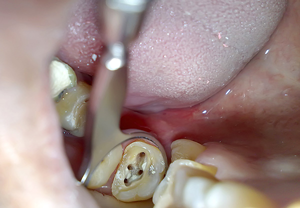 Po kvalitnej úprave zubných kanálikov niekedy cysta v koreňovom kmeni zmizne.