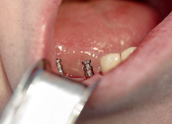 Parlem dels tipus d’implants dentals que existeixen avui en dia i dels preus d’aquest procediment ...