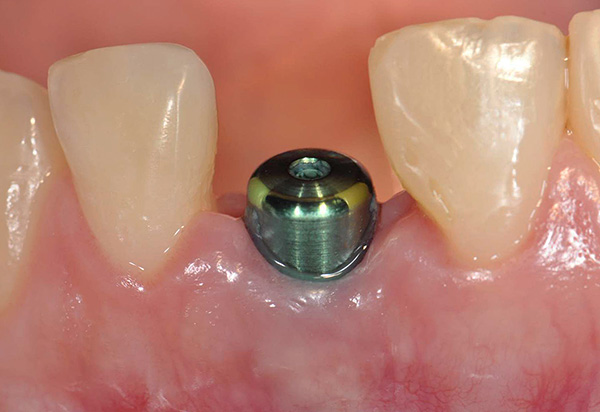 De patiënt loopt lange tijd met de gingiva-mal terwijl de osseo-integratie van het implantaat aan de gang is.