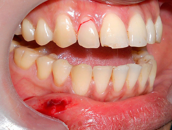 Sprekken i tannen er tydelig synlig på fotografiet - den er ikke lenger gjenstand for restaurering, den er ment å bli fjernet med påfølgende protetikk på implantatet.