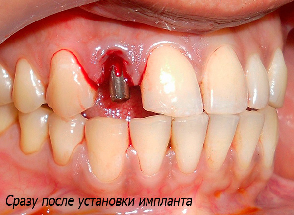 Непосредна имплантација подразумева постављање имплантата у рупу одмах након вађења зуба.