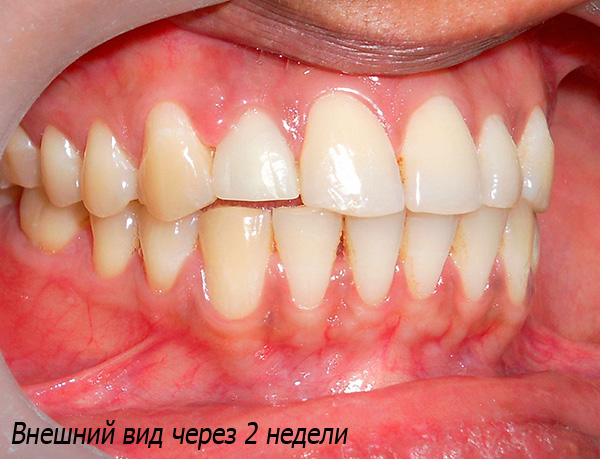 Ini adalah bagaimana hasil implantasi kelihatan selepas 2 minggu - gigi tiruan tidak dapat dibezakan daripada saudara-mara.