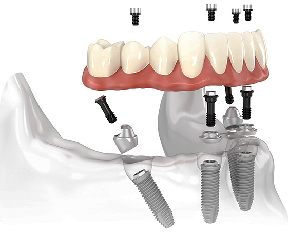 Viens no populārākajiem zobu implantu veidiem mūsdienās ir tehnoloģija All-on-4.