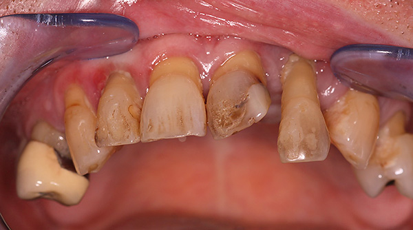 Das Foto zeigt das Aussehen der Zähne vor der Prothetik ...