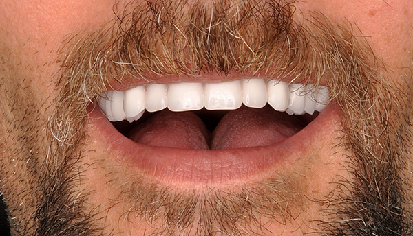 Η εμφύτευση των δοντιών με άμεση φόρτωση σας επιτρέπει να πάρετε ένα τέτοιο χαμόγελο σε σύντομο χρονικό διάστημα, με μια τιμή περίπου 300.000 ρούβλια.