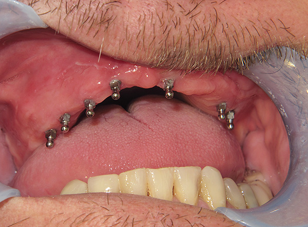 Med den såkalte miniimplantasjonen av tenner, kan protesen installeres bare noen få dager etter implantasjonen av miniimplantater.