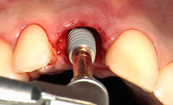 La foto muestra un ejemplo de instalación de un implante en el pozo de un diente recién extraído.