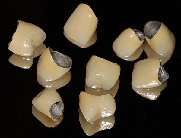 Ceramic-metal crowns are quite aesthetic and reliable at a relatively low cost.