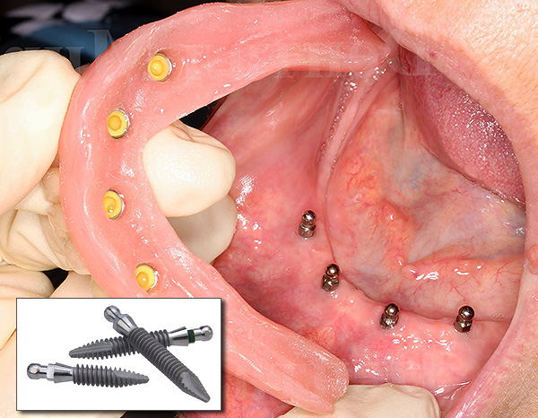Mini implanturi contribuie la retenția fiabilă a unei proteze amovibile pe maxilar.