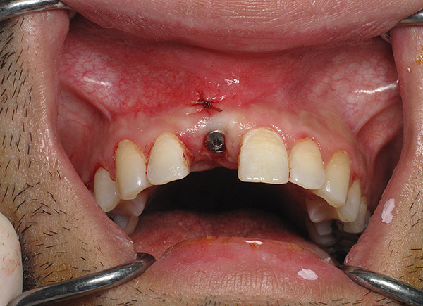 Gleivinės apipavidalinimui įdiegto implanto srityje naudojamas vadinamasis dantenų formavimo įrenginys.
