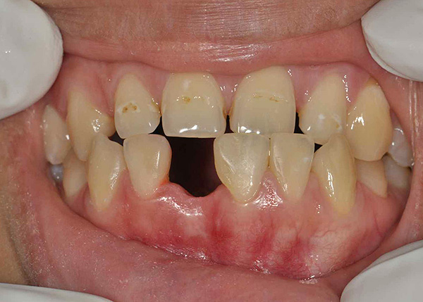 Ant apatinio žandikaulio buvo pašalintas vienas iš priekinių dantų, skylė jau užgijo.