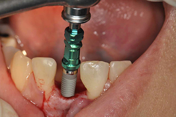 Schritt zur Platzierung des Zahnimplantats