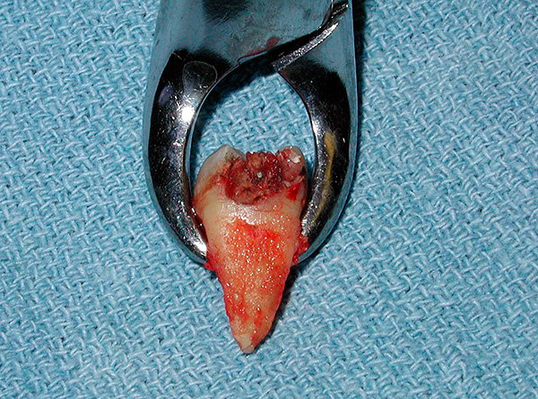 Să vorbim despre extracția dinților și cum să reducem probabilitatea problemelor chiar și după o procedură complexă ...