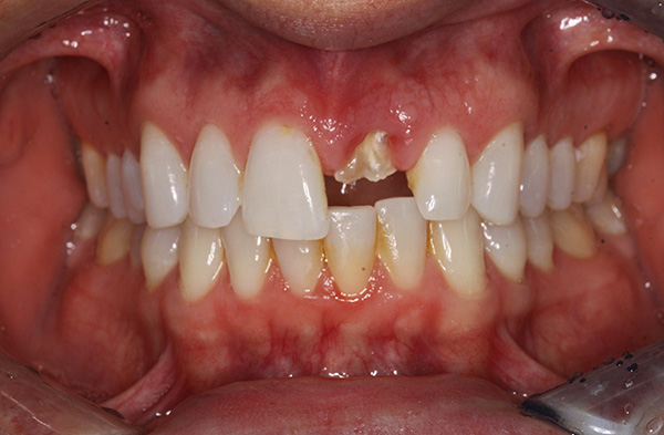 După îndepărtarea rădăcinii, dintele frontal poate fi restabilit pe implant.