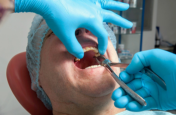 De tand wordt stevig in het gat gehouden door het ligamentaire apparaat, dus de arts moet aanzienlijke inspanningen leveren bij het losmaken.