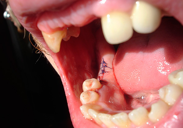 Met een aanzienlijke wond gevormd na het trekken van tanden, kan de kaakchirurg naaien.