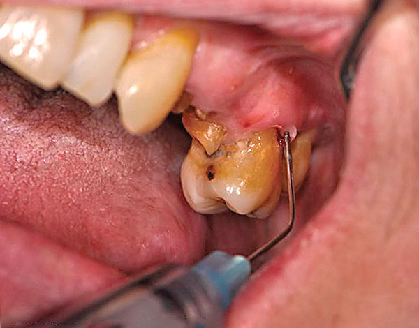 La calidad de la anestesia depende completamente de la intensidad del dolor durante la extracción del diente.