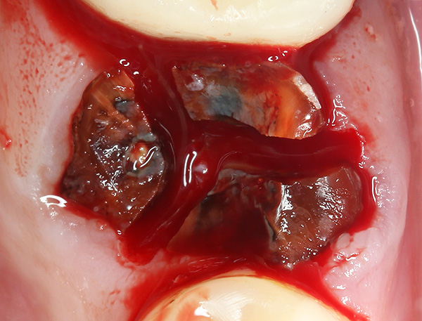 De tand wordt in drie delen gezaagd (door het aantal wortels), zodat het gemakkelijker te verwijderen is met minimaal trauma aan het omringende weefsel.