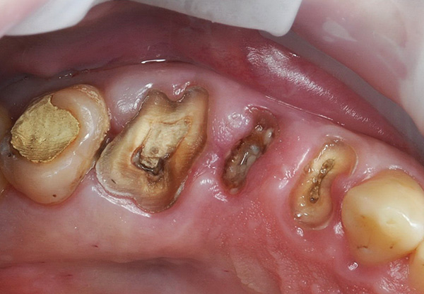 De drie te extraheren tanden zijn voorgesneden tot op het gingivale niveau.