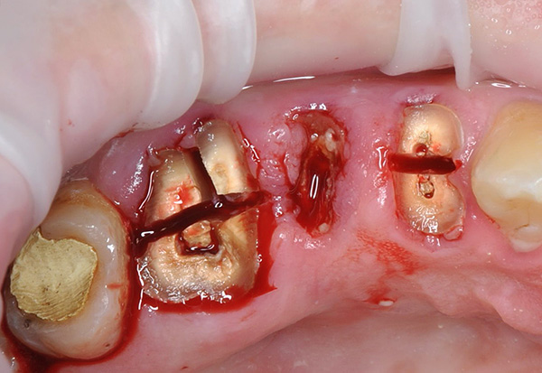 Innan tänderna tas bort sågas tänderna av en borr i delar ...