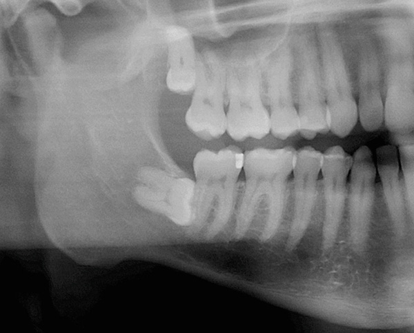 Na obrázku je jasne viditeľná sietnica zubu múdrosti ležiaca vodorovne v kosti dolnej čeľuste.
