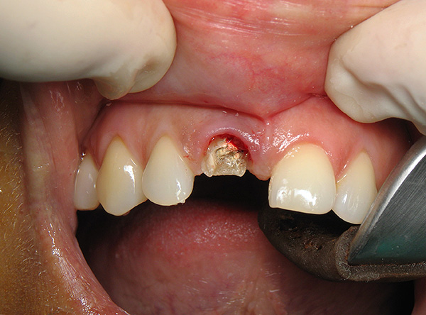 La actitud inadecuada de los pacientes ante el problema de la extracción dental y la poca conciencia de esta operación a menudo conducen a graves consecuencias.