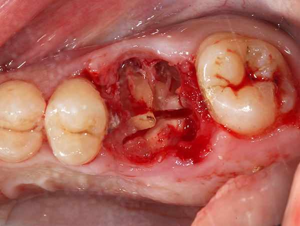 Μερικές φορές οι ρίζες του δοντιού χωρίζονται μεταξύ τους με μια σμίλη και ένα σφυρί, και μερικές φορές κόβονται με ένα τρυπάνι.