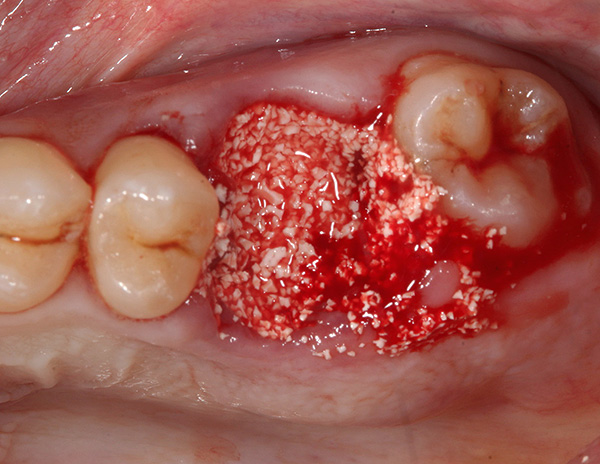 Fotoattēlā parādīts piemērs, kā zobu caurumu piepildīt ar mākslīgo kaulu materiālu.