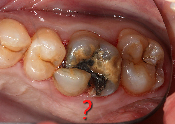 In einigen Fällen kann es schwierig sein, eindeutig zu sagen, ob ein Zahn entfernt werden soll oder ob er noch gerettet werden kann.
