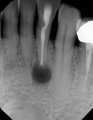 La imatge mostra una dent amb un quist a la zona d’arrel.