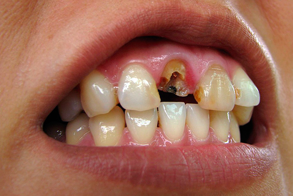 A menudo, el diente se rompe para que la raíz ya no se pueda usar como soporte para el inserto y la corona; en este caso, la raíz está sujeta a extracción.