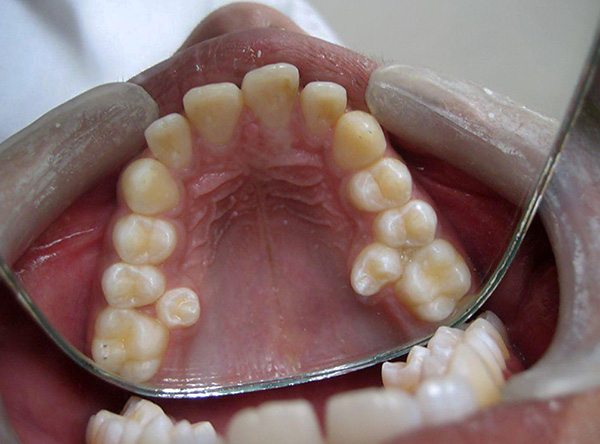 Τα υπεράριθμα δόντια συνήθως απομακρύνονται.