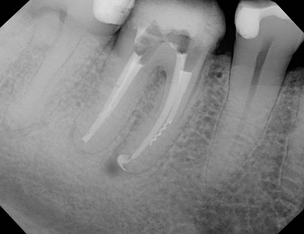 Das Fragment eines zahnärztlichen Instruments im Wurzelkanal des Zahns ist im Bild deutlich sichtbar - häufig führt dies im Laufe der Zeit zu Entzündungen an der Wurzel.