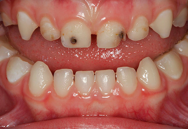 I mléčné zuby, pokud je to nutné, musí být ošetřeny, aby nedošlo k předčasné ztrátě.