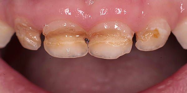 Otra foto con un ejemplo de caries de dientes deciduos en un niño.