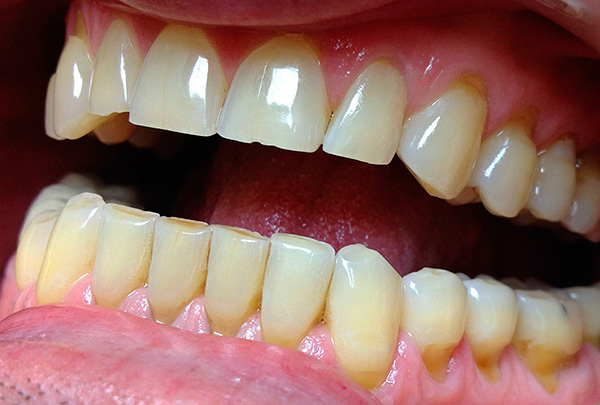 Kama şeklindeki kusurların alanı genellikle artan diş ile karakterizedir, çünkü diş minesi burada inceltilir.