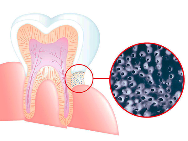 На слици је схематски приказана изложеност дентина у цервикалном подручју зуба - дентин је прожет најтанијим тубулима који воде до пулпе.