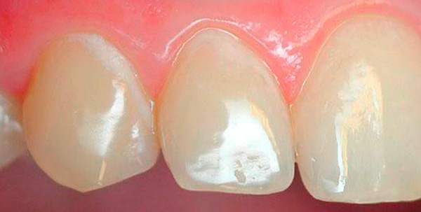 Bílé oblasti na zubech jsou oblasti intenzivní demineralizace skloviny (kaz ve fázi bílé skvrny).