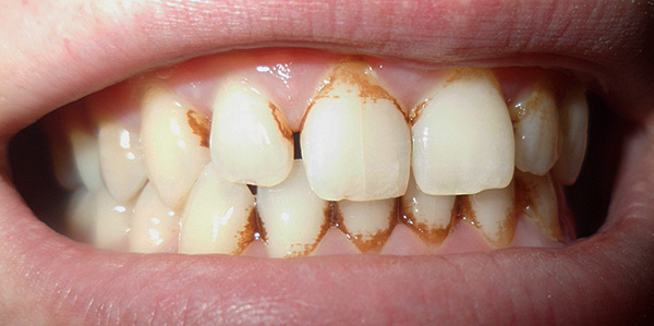 При ясно изразена зъбна плака избистрящите свойства на пастата Нежното избистряне на емайла може да не е достатъчно.