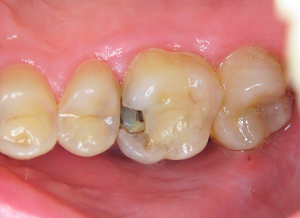 Mikään hammastahna ei palauta hampaita, jos niihin on jo muodostunut syviä karioontelot.