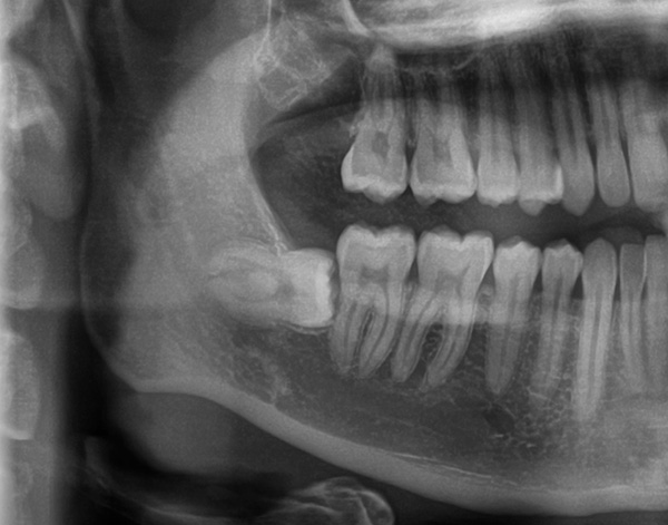 Satu gigi bijak separa bertetulang terletak secara mendatar di tulang rahang.