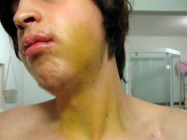 The hematoma can reach impressive dimensions, capturing, including the neck.