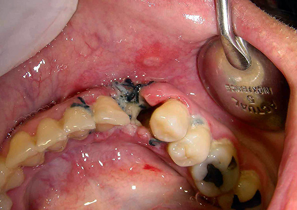Alvéolite (inflammation du trou après extraction dentaire).