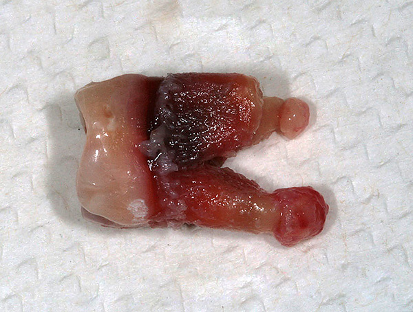 Zub s cystami na kořenech