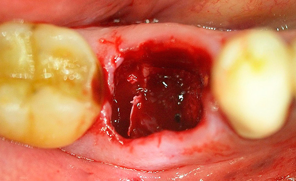 Jika tisu-tisu yang dijangkiti hadir pada akar gigi, maka di masa depan ini boleh menyumbang kepada peradangan telaga (termasuk perkembangan alveolitis).
