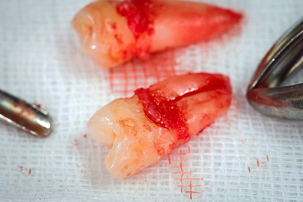 Souvent, un chirurgien-dentiste doit retirer des dents complètement saines - par exemple, des dents de sagesse.